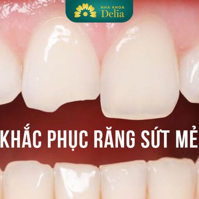 Tính thẩm mỹ của hàm răng và khuôn mặt giảm thiểu nghiêm trọng khi răng sứt mẻ