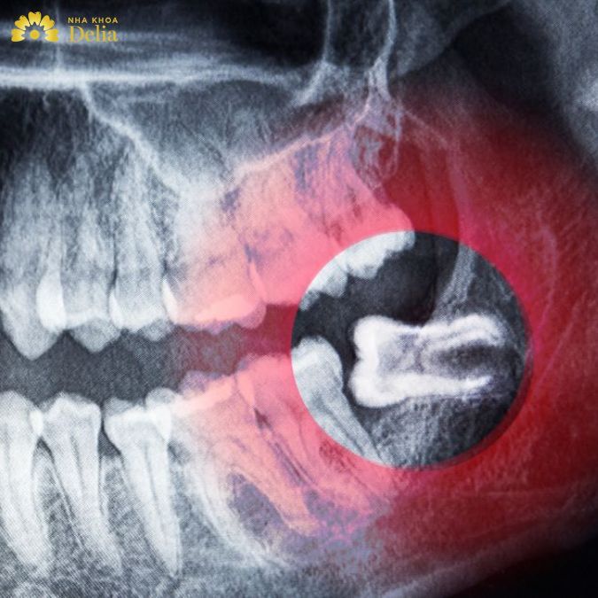 Đây là tình trạng răng số 8 không có đủ chỗ để mọc, đâm khỏi lợi khiến răng sau khi mọc bị xiêu vẹo, nghiêng