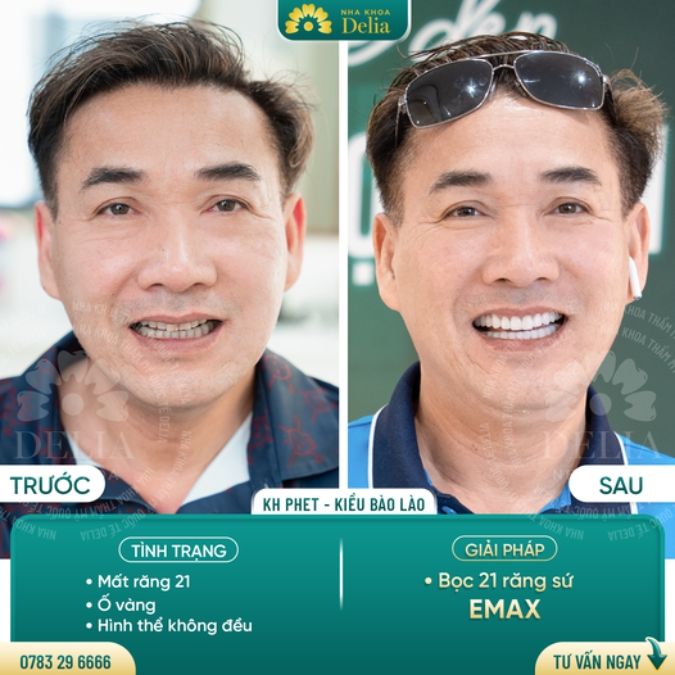 Bọc răng sứ cao cấp ở đâu uy tín tại Hà Nội và TP.HCM?