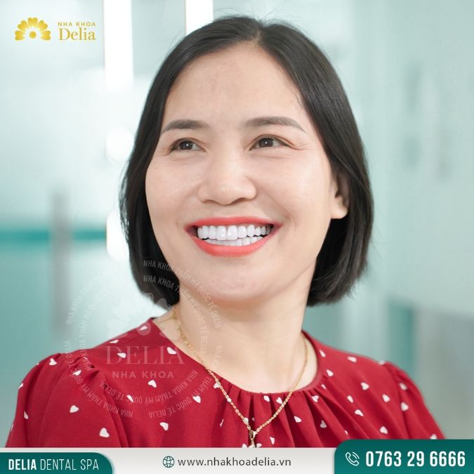 Sứ Ceramic có tính thẩm mỹ cao