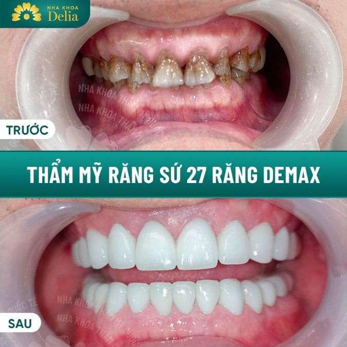 Răng toàn sứ Demax Plus