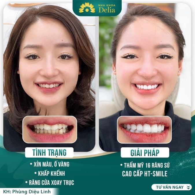 Tình trạng răng nào có thể bọc răng sứ HT Smile?