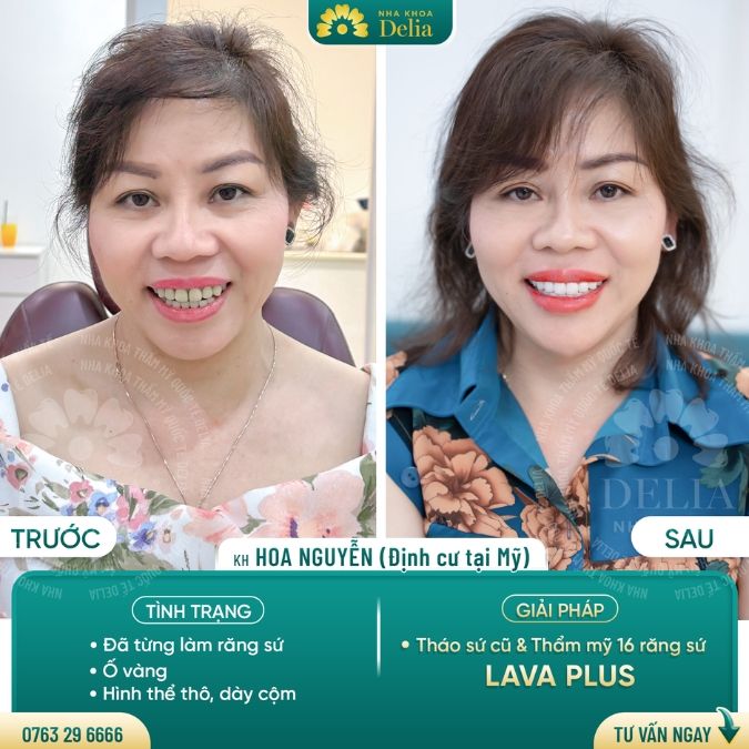 Nhược điểm của răng toàn sứ Mỹ