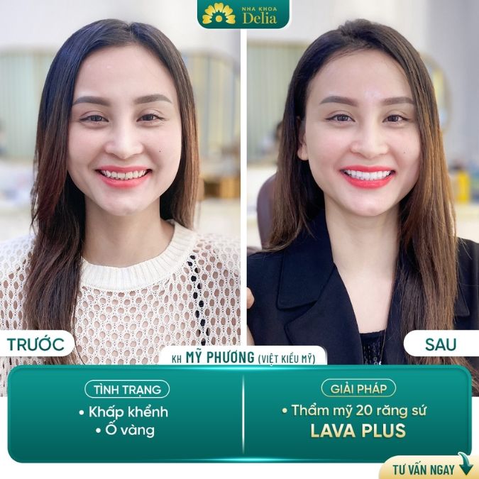 Răng sứ Mỹ có đắt không? Răng sứ Mỹ giá bao nhiêu?