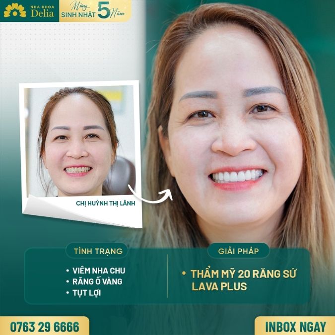 Răng sứ Mỹ có đắt không? Răng sứ Mỹ giá bao nhiêu?