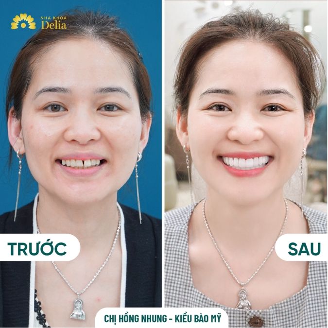 Có nên dùng răng sứ Mỹ không?
