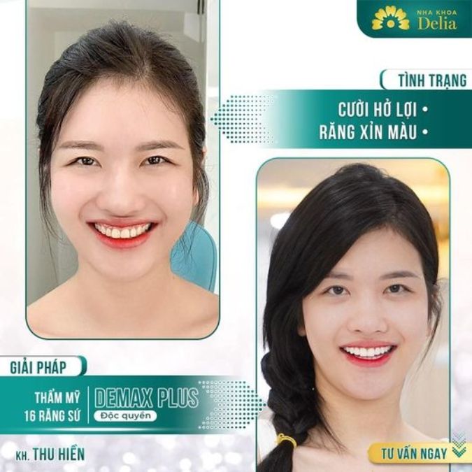 Răng sứ Demax - răng sứ Mỹ độc quyền tại nha khoa Delia