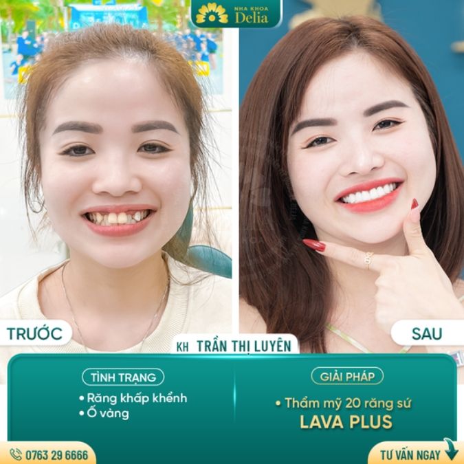 Răng sứ Lava - răng toàn sứ Mỹ được yêu thích