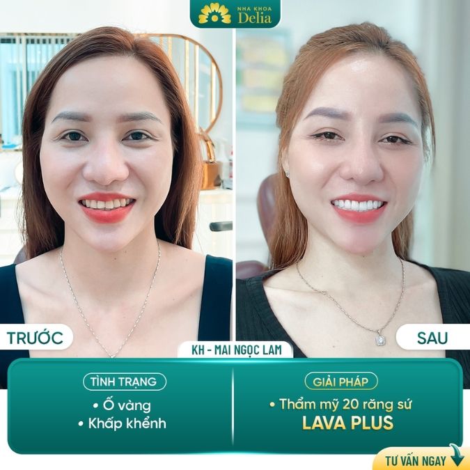 Bọc răng sứ Mỹ có vai trò gì?