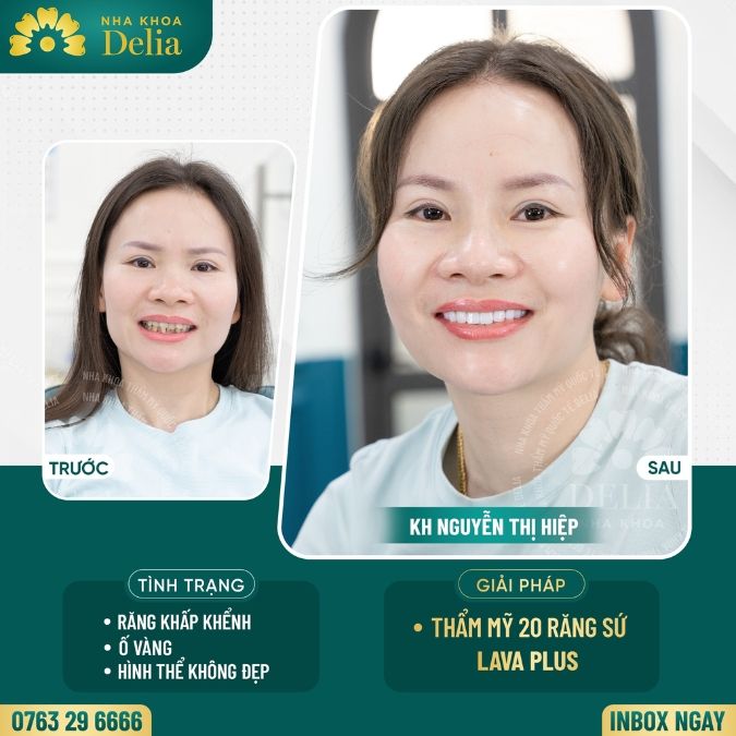 Bọc răng sứ Mỹ có vai trò gì?