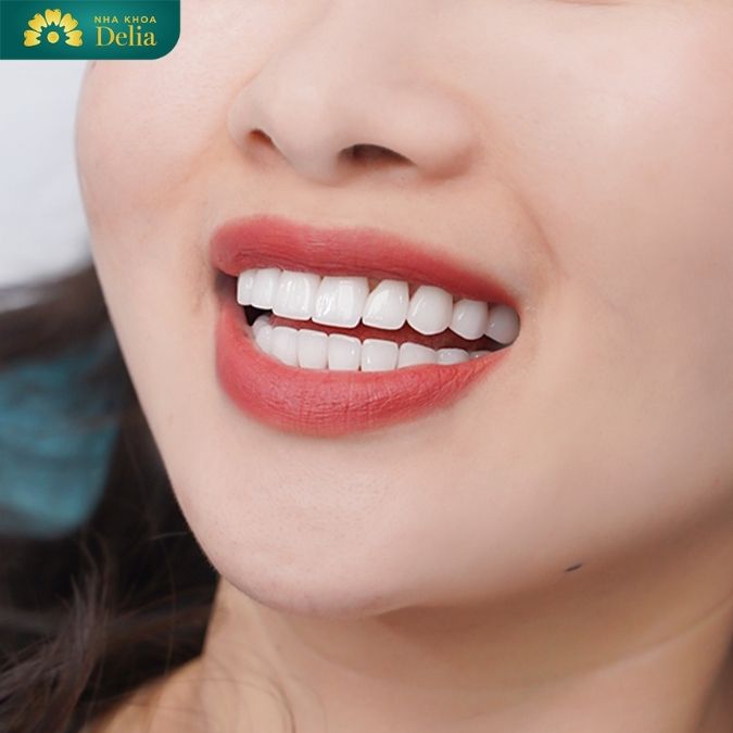 Răng sứ Nhật giá bao nhiêu? Giá răng sứ Katana Nhật Bản