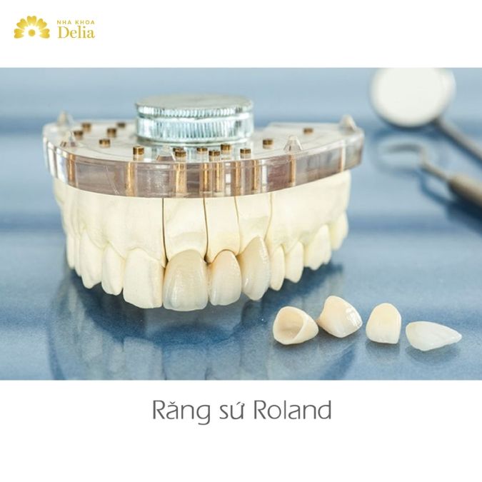 Răng sứ Roland có đặc điểm gì? Răng sứ Roland có nguồn gốc xuất xứ từ đâu?