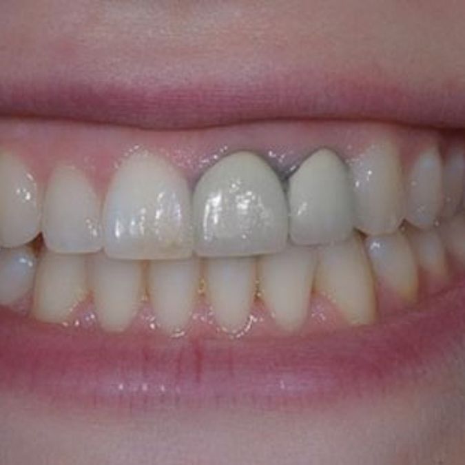 Bọc răng sứ kim loại titan có màu sắc kém tự nhiên