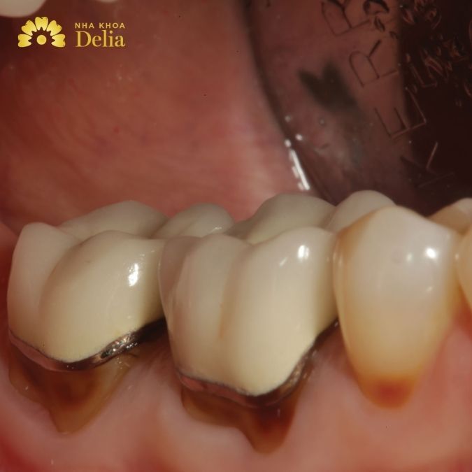 Bọc răng sứ titan có độ bền kém
