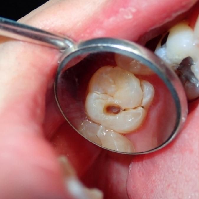 Dùng răng sứ titan có hại không?