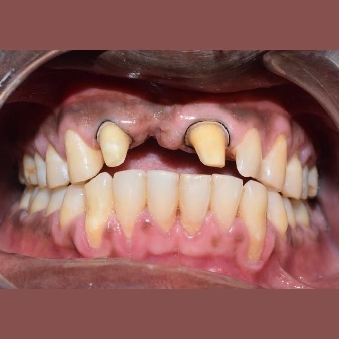 Thời gian sử dụng răng sứ titan là bao lâu?