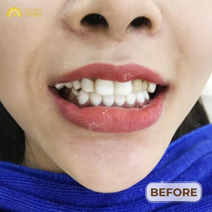 Cách nhận biết răng sứ Zirconia Trung Quốc với Đức?