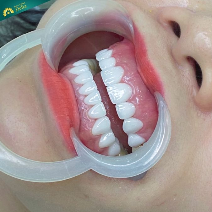 Cách nhận biết răng sứ Zirconia Trung Quốc với Đức?