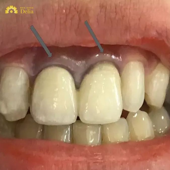 Đặc trưng của dòng răng sứ Zirconia Trung Quốc