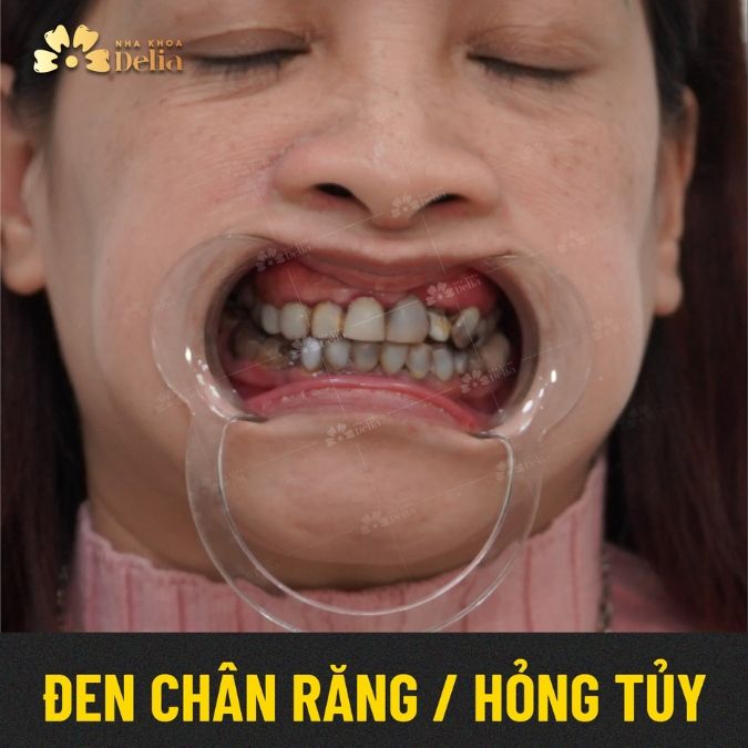 Hậu quả khôn lường nào khi bọc răng sứ Trung Quốc?