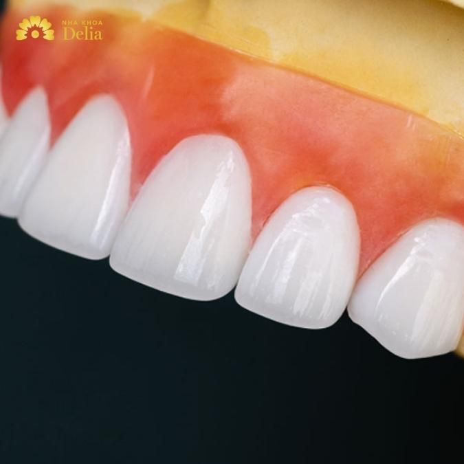 Răng sứ Multi có thể sử dụng cho các trường hợp nào?
