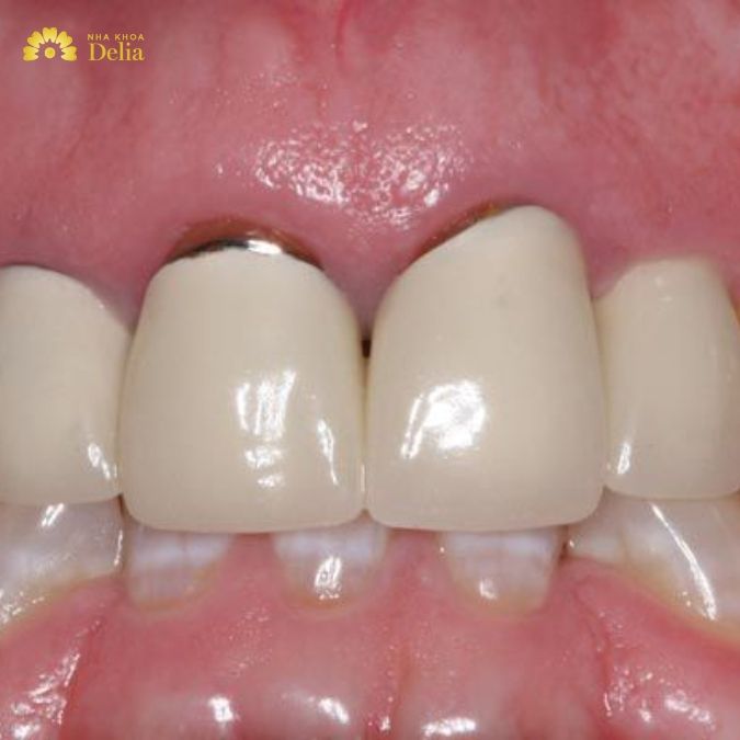Nguy cơ đen viền nướu của răng toàn sứ và răng kim loại