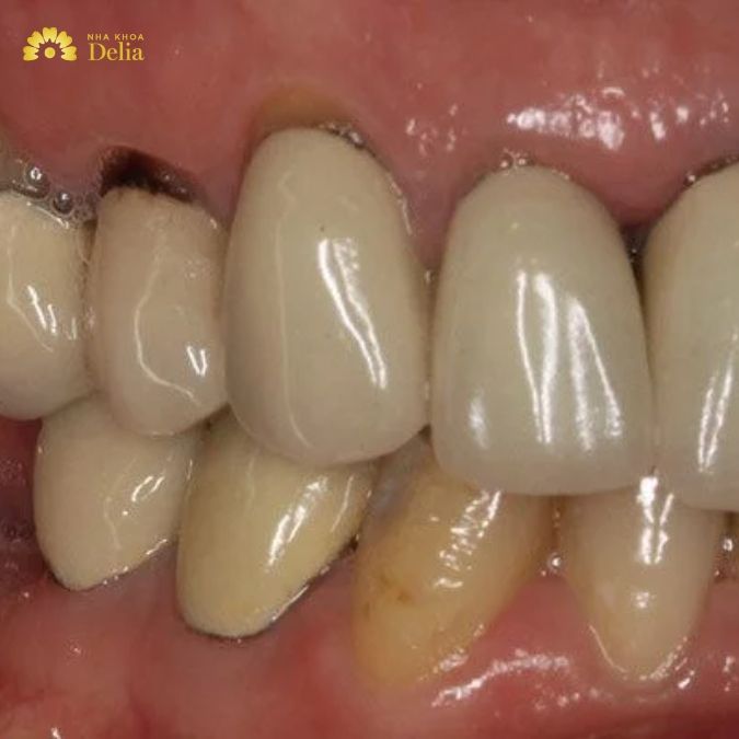 Khả năng thích ứng của răng toàn sứ và răng sứ kim loại
