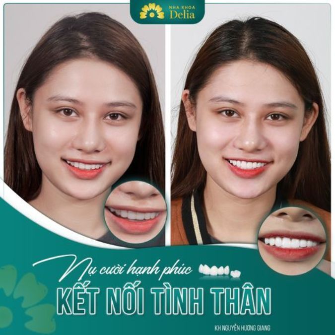 Những người trẻ tuổi thường lựa chọn màu răng có phần trắng sáng và bóng hơn