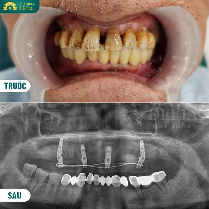 Khi chân răng bị rỗng không thể giữ lại, bác sĩ sẽ tiến hành nhổ bỏ và trồng lại răng mới