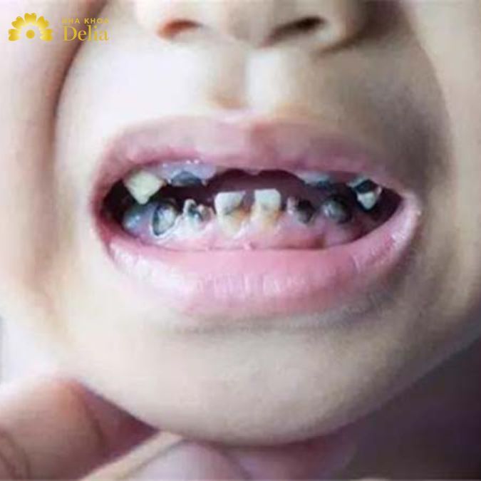 Trẻ em có nguy cơ bị sâu răng rất cao