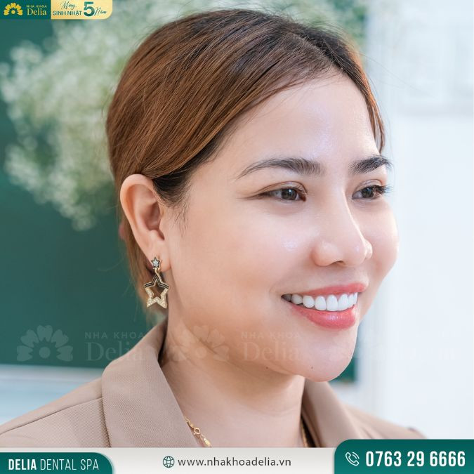 Răng sứ Emax
