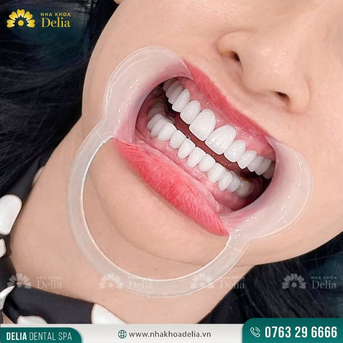 Răng sứ Titan có chất lượng không tốt bằng răng sứ toàn sứ