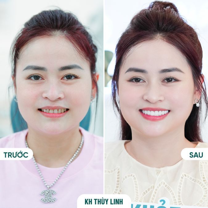 Dòng sứ Orodent Innovation cao cấp nhất hiện nay mang đến vẻ đẹp hoàn mỹ cho KH Thùy Linh