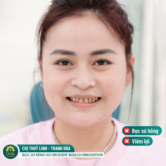 Chị Thùy Linh đến với nhau khoa Delia trong tình trạng răng bọc sứ hỏng, viêm lợi và ố vàng