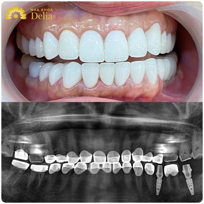 Trồng răng hàm bị sâu bằng phương pháp nào tốt nhất?