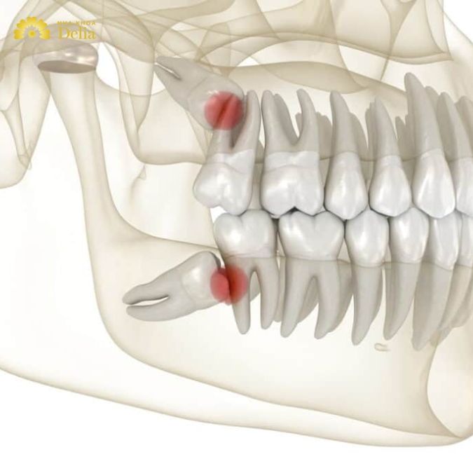 Tại sao răng khôn thường được nhổ bỏ thay vì giữ lại?