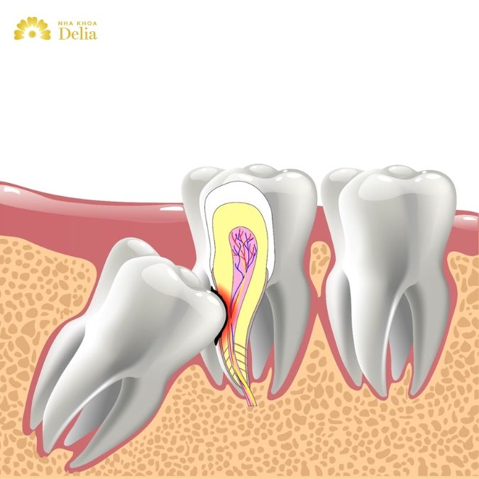 Tại sao răng khôn thường được nhổ bỏ thay vì giữ lại?