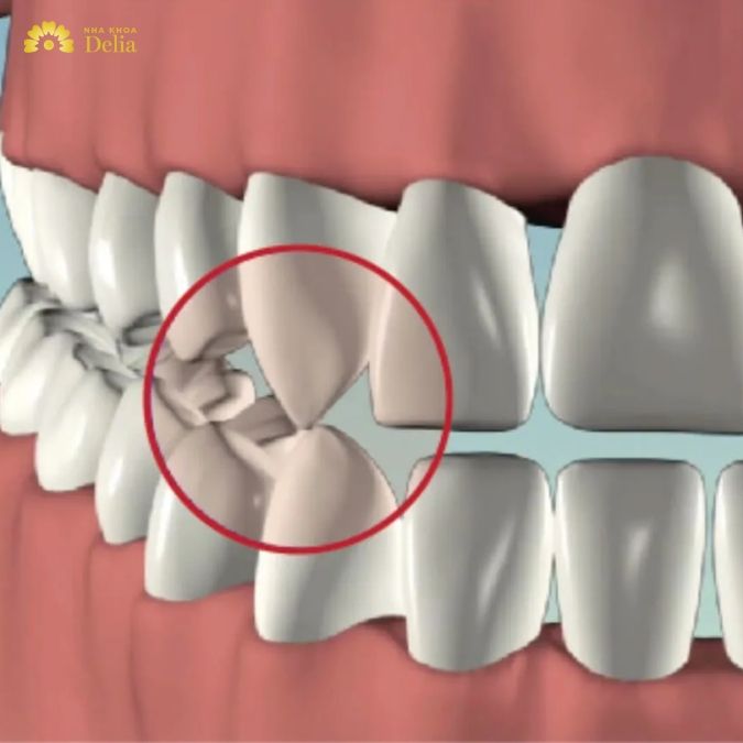 Răng nanh nằm ở vị trí nào trên cung hàm?