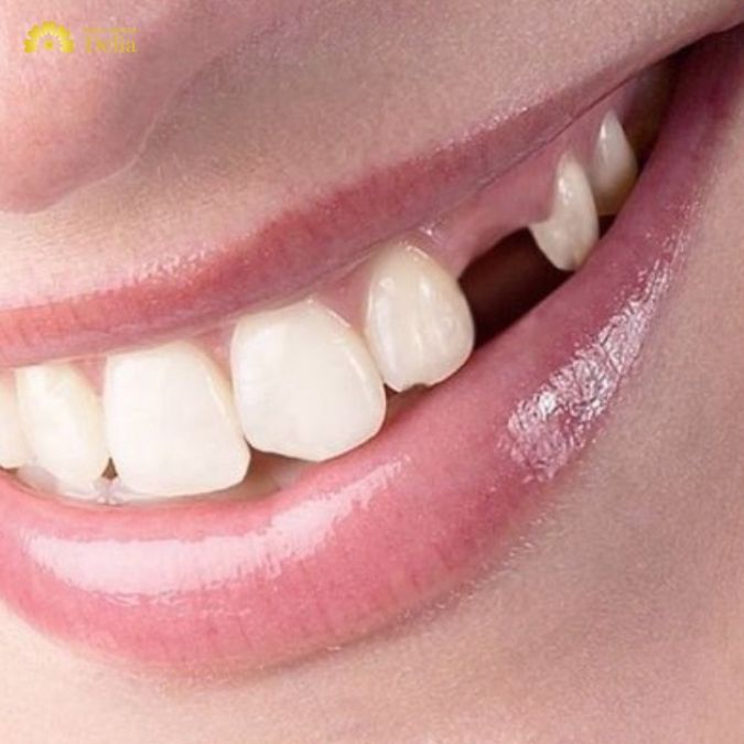 Một số nguyên nhân có thể làm mất hoặc tổn thương răng nanh