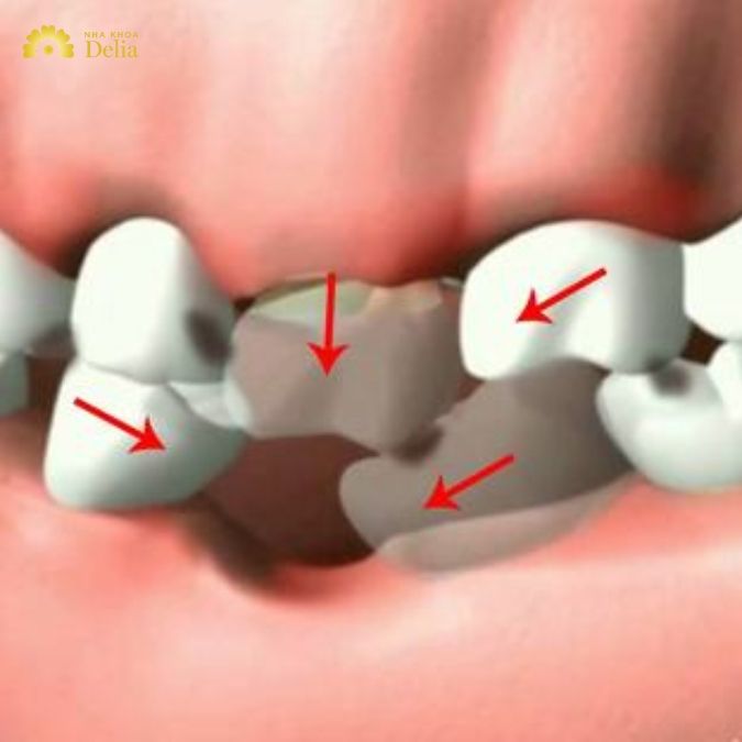 Mất răng nhai có thể gây ra những hậu quả gì?