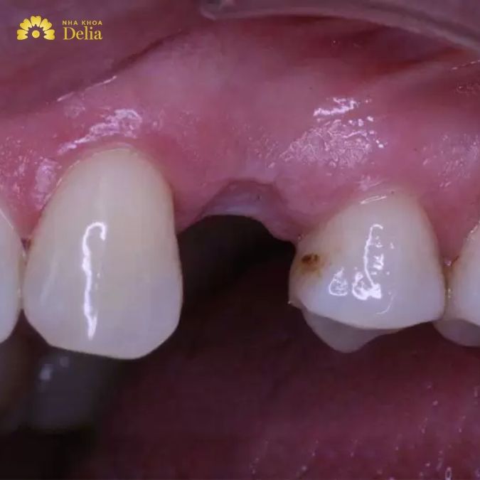 Răng số 4 là răng nào?