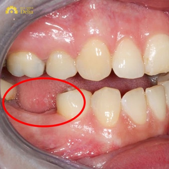 Mất răng số 6 có thể gây ảnh hưởng như thế nào?