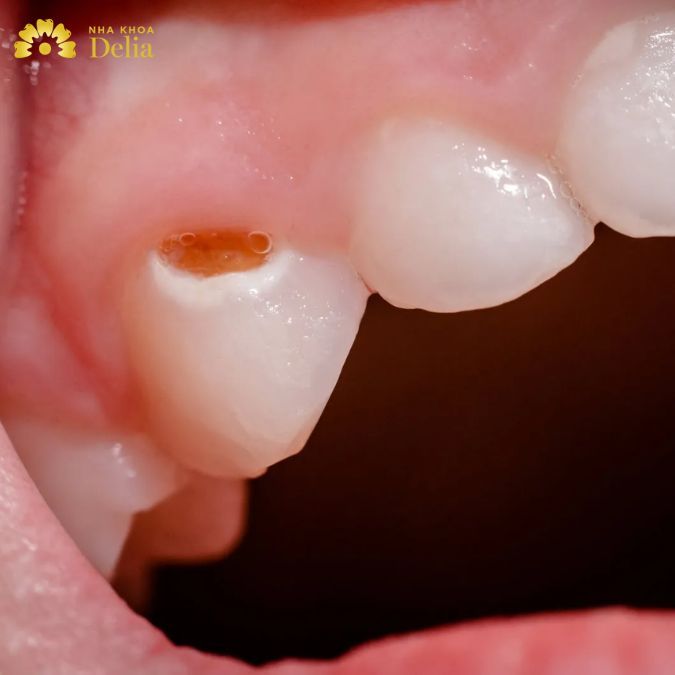 Viêm tủy răng trong giai đoạn nhẹ, chưa có nhiều dấu hiệu đau nhức, khó chịu