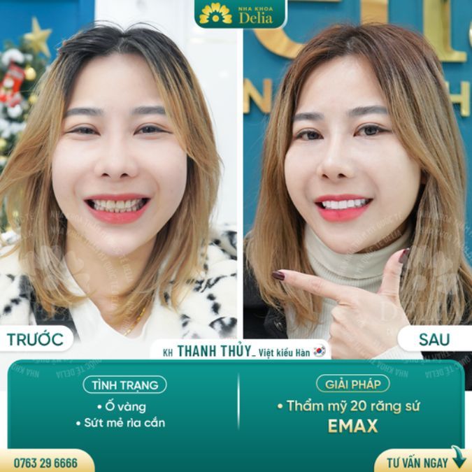 Răng mẻ đặc biệt là răng cửa rất dễ nhìn thấy ảnh hưởng tới tính thẩm mỹ