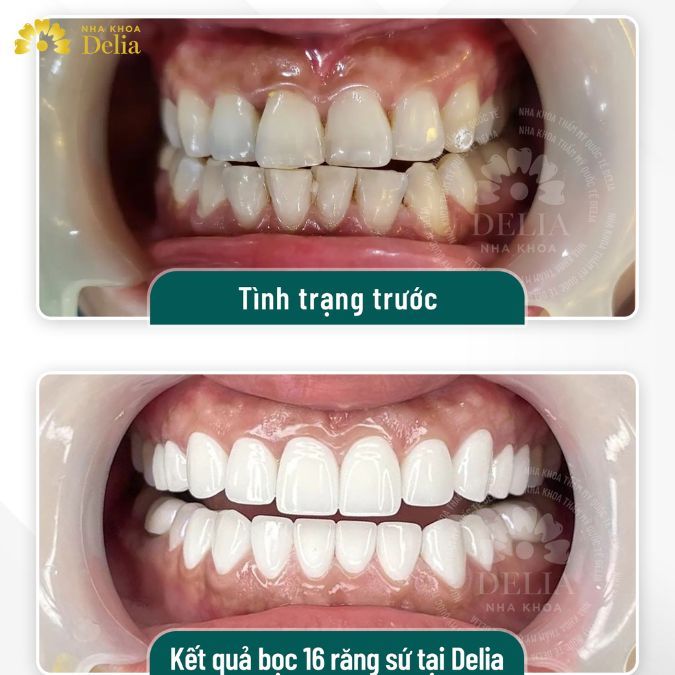 Một phương pháp toàn diện hơn phục hình răng bị mẻ được nhiều người lựa chọn là bọc răng sứ