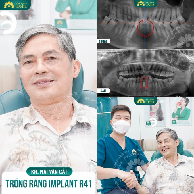 Bác sĩ Nguyễn Xuân Việt thực hiện thành công > 1000 ca trồng răng Implant mỗi năm