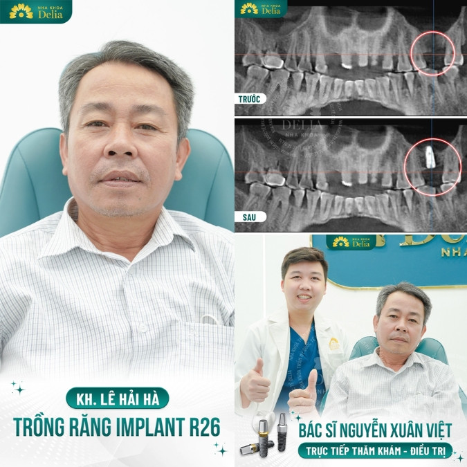 Bác sĩ Nguyễn Xuân Việt thực hiện thành công > 1000 ca trồng răng Implant mỗi năm