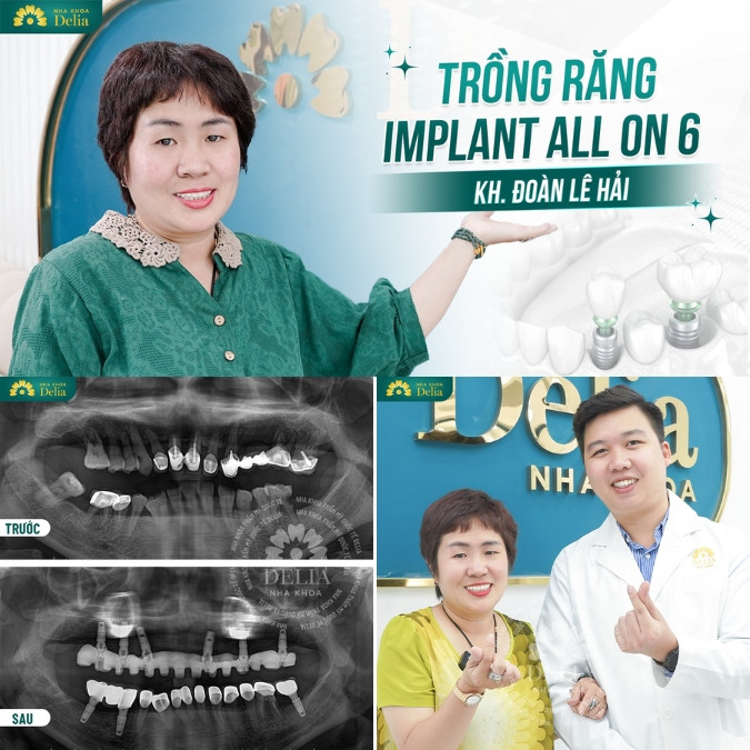 Bác sĩ Nguyễn Xuân Việt thực hiện thành công > 1000 ca trồng răng Implant mỗi năm
