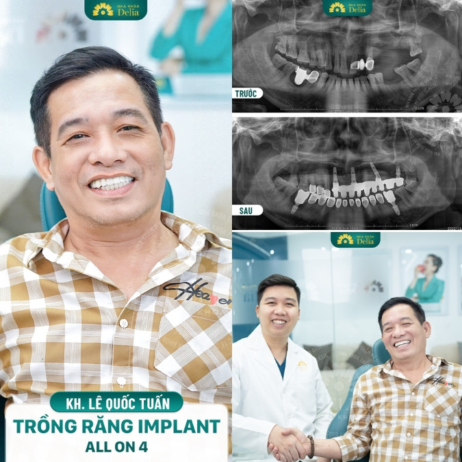 Bác sĩ Nguyễn Xuân Việt thực hiện thành công > 1000 ca trồng răng Implant mỗi năm
