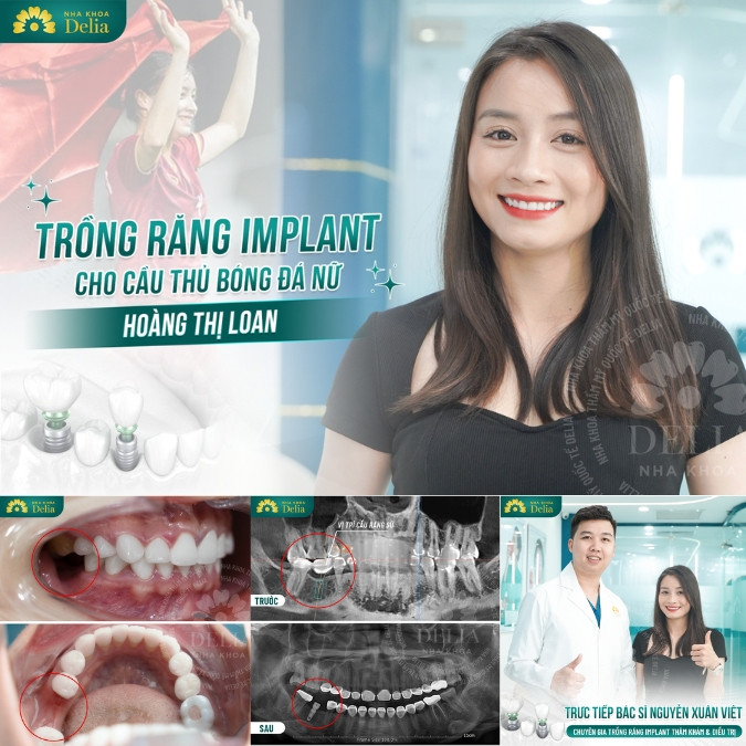 Bác sĩ Nguyễn Xuân Việt thực hiện thành công > 1000 ca trồng răng Implant mỗi năm